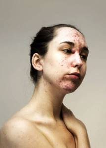 Серия портретов женщин с проблемной кожей и без макияжа